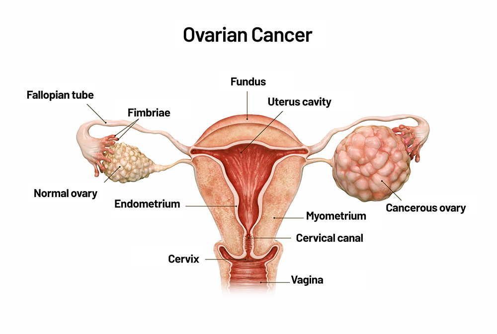 Ovarian Cancer Treatment in Bikaner