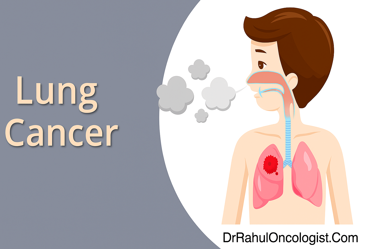 Lung Cancer Treatment in Bikaner