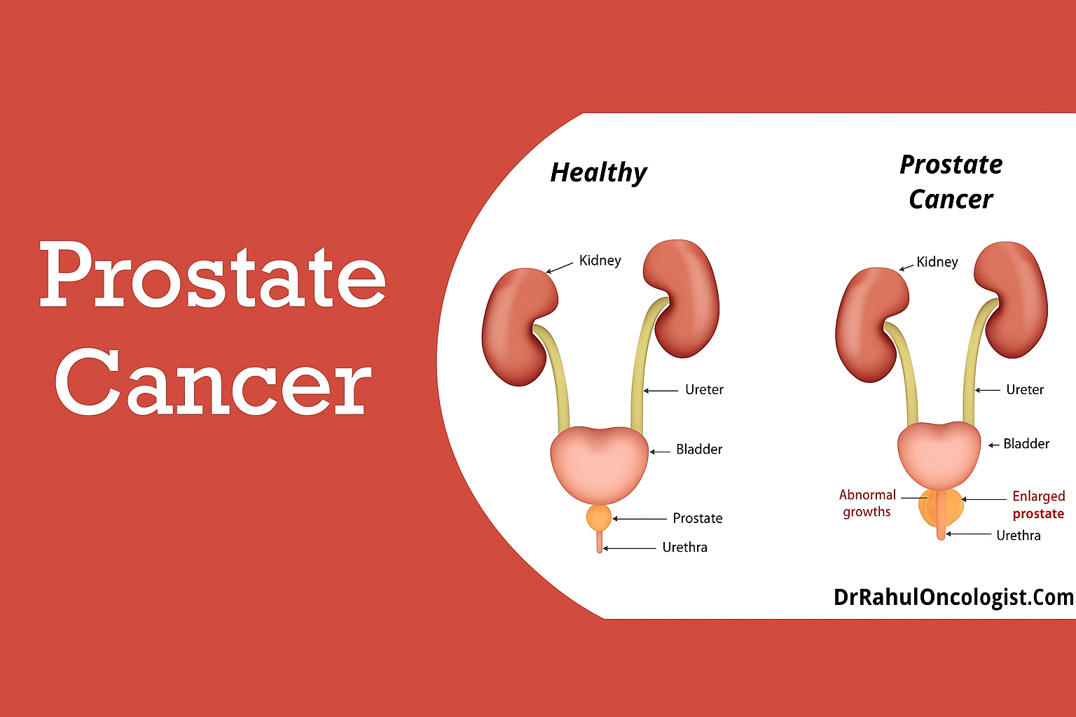Prostate Cancer Treatment in Bikaner