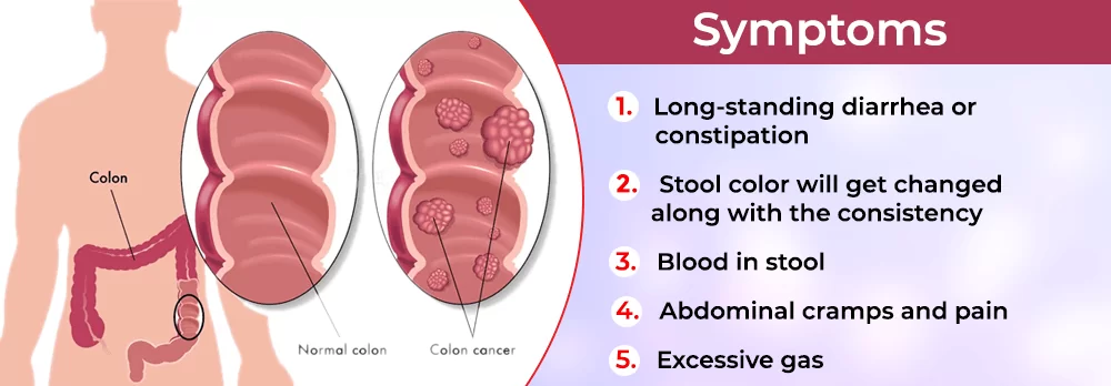 Colon cancer Treatment in Bikaner By Dr Rahul Oncologist, Best Oncologist in Bikaner
