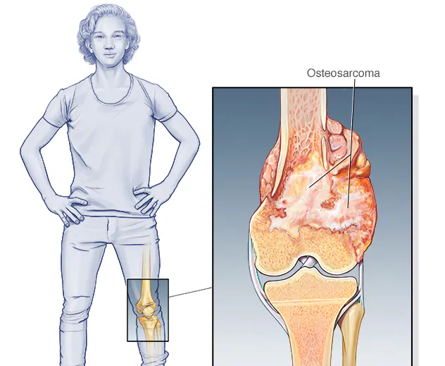Osteosarcoma Cancer