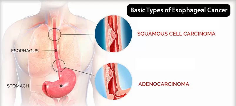 Esophageal Cancer Treatment in Bikaner