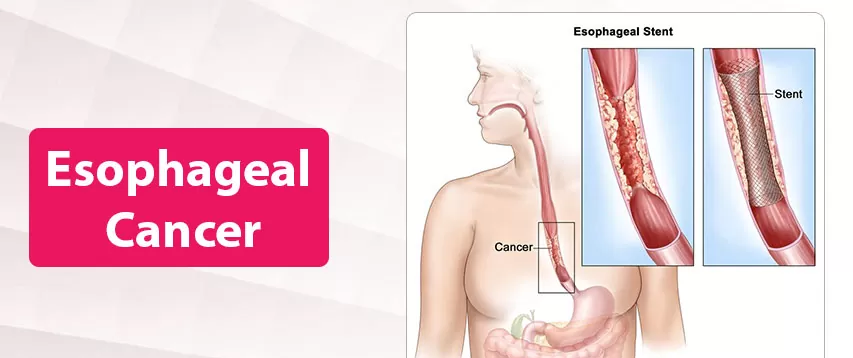 Esophageal Cancer Treatment in Bikaner