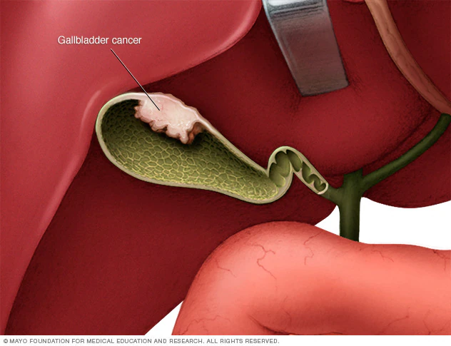 Gallbladder Cancer Treatment in Bikaner