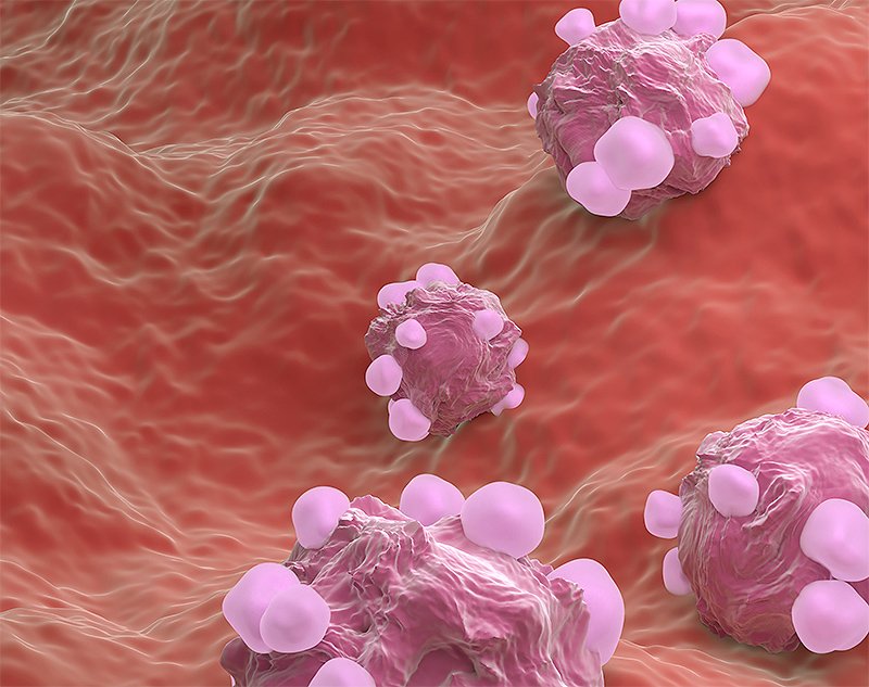 Ovarian Cancer Treatment in Bikaner